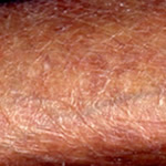 皮脂欠乏性湿疹