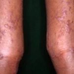 アトピー性皮膚炎