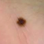 ほくろ